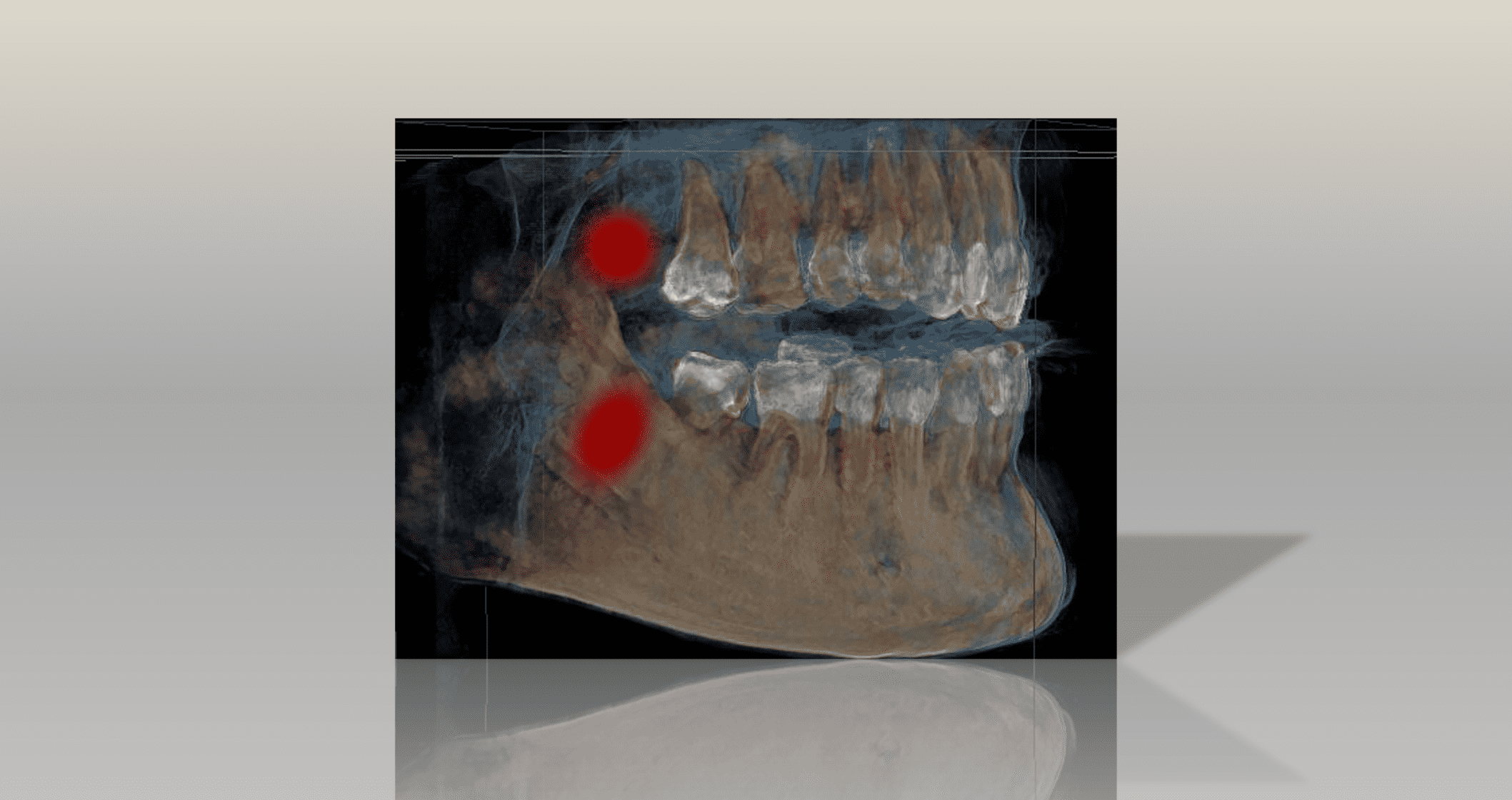 Cavitation procedure in dr roze dental clinic dubai