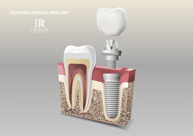 best ceramic dental implants in dubai