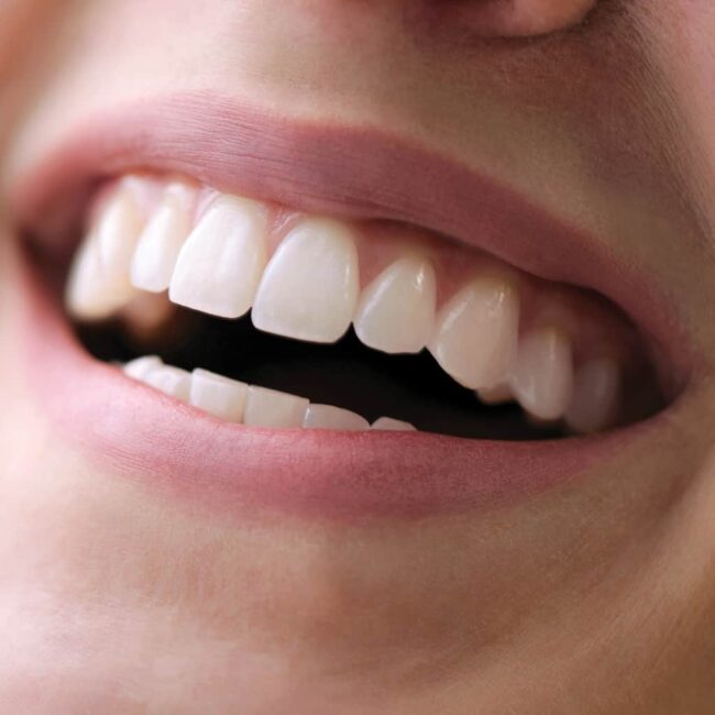 Beautiful Smile Veneers