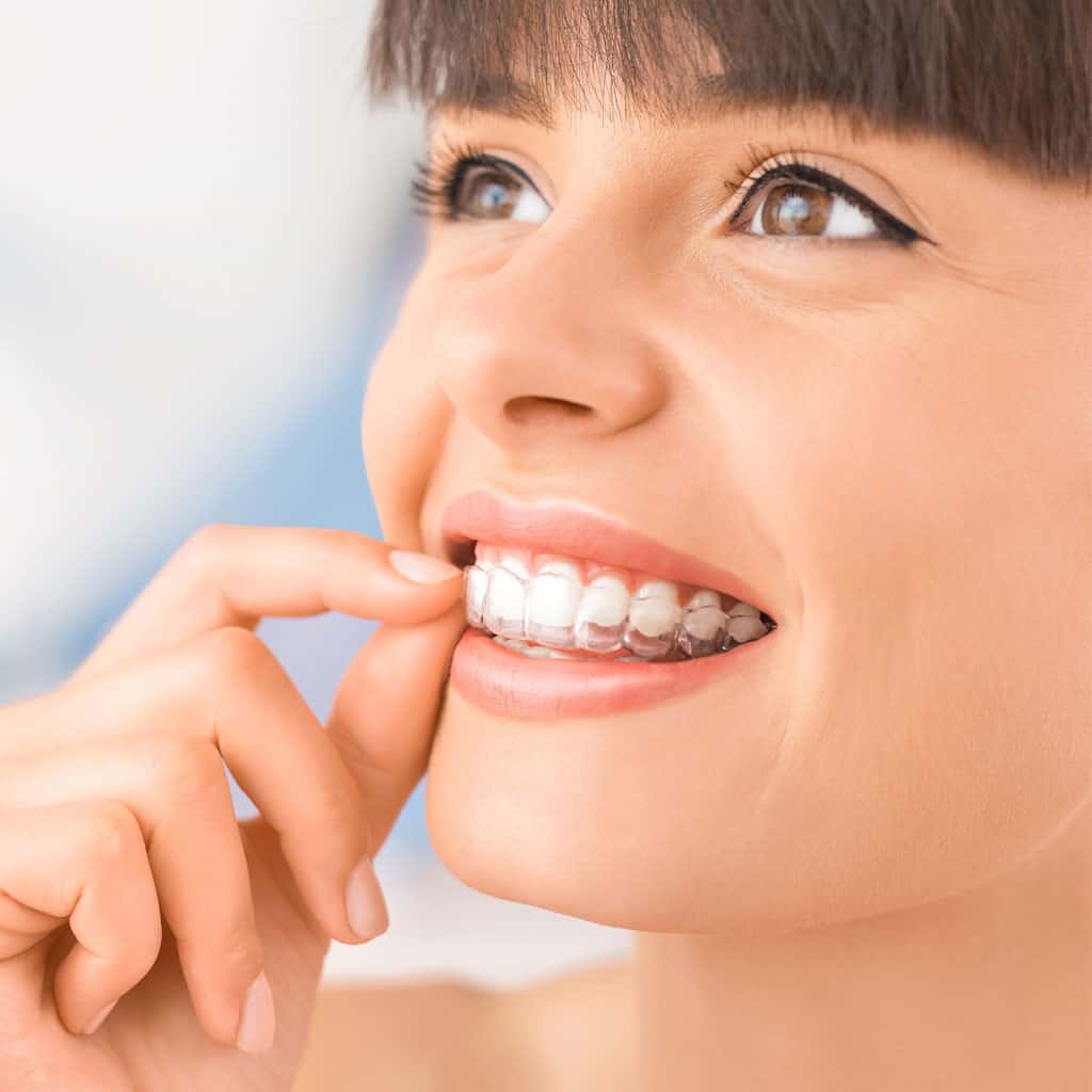 What are the Real benefits of Invisalign