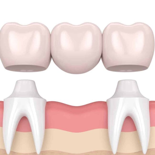 Dental Bridges