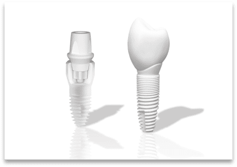 Ceramic Dental Implants Ceramic Dental Implants