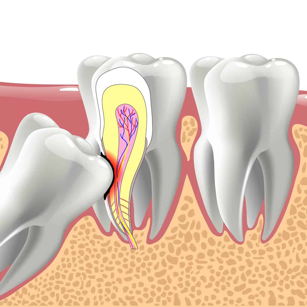 why-do-people-remove-their-wisdom-teeth