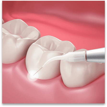 cavitation treatment cavitation treatment