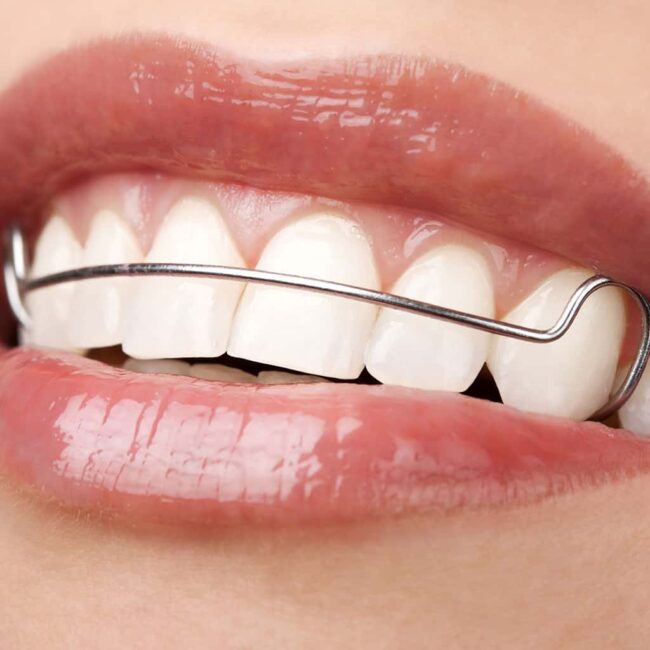 dental retainers