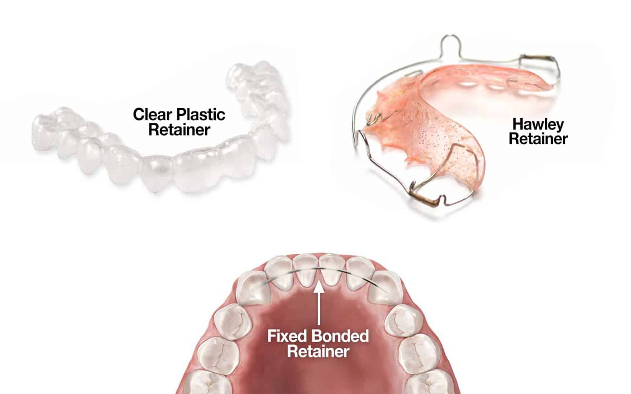 Teeth Retainers In Dubai | Dr Roze Biodental Clinic