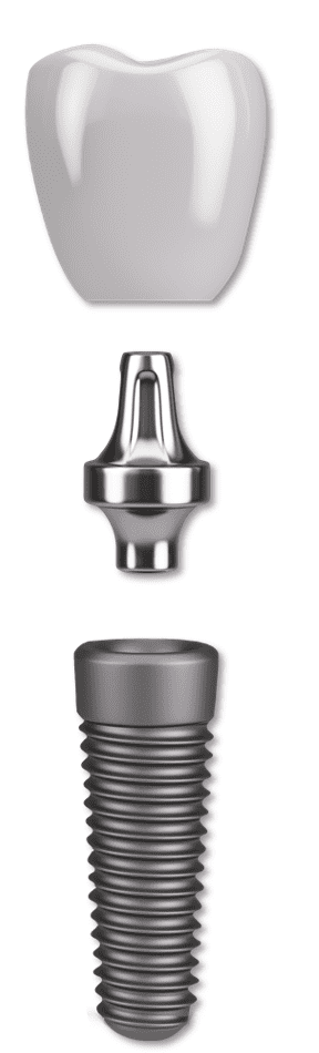 Titanium implant + titanium abutment 1980’s