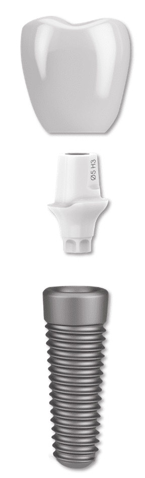 Titanium implant + zirconia abutment 2000’s