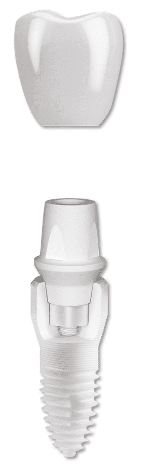 Tapered, screw retained internal connection Zirconium Implant 2020