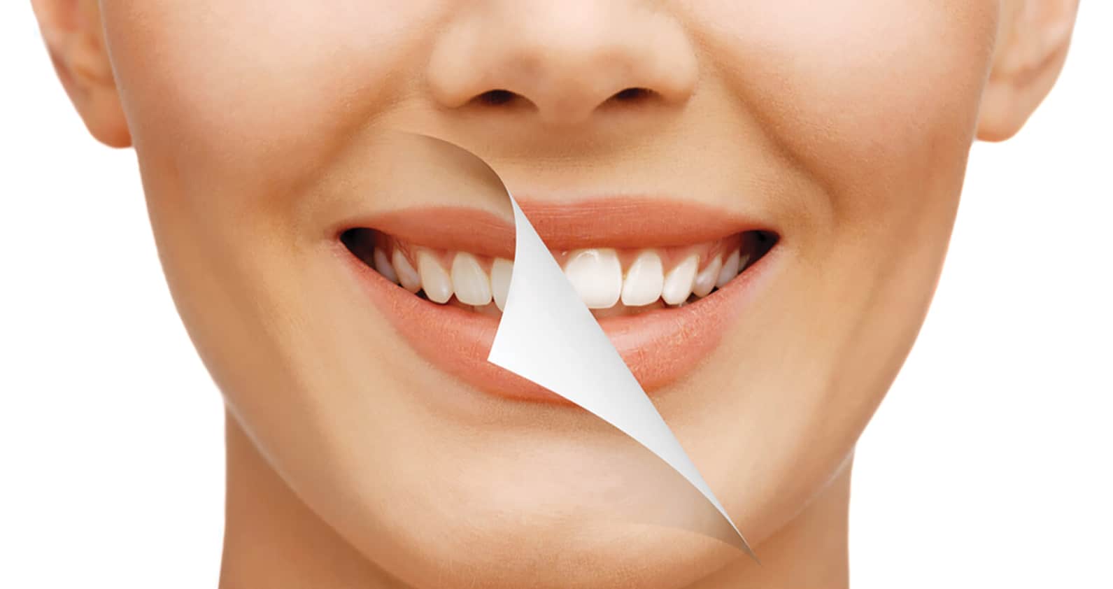 Teeth_whitening_dubai