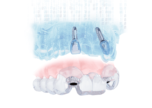 computer-guided implant surgery_2 computer-guided implant surgery_3