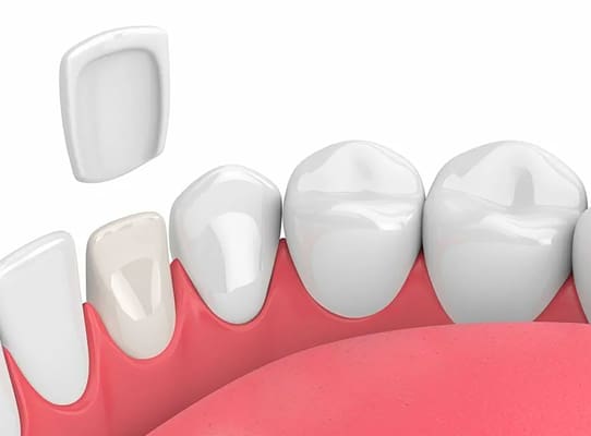 feldspathic veneers_drroze feldspathic veneers_drroze