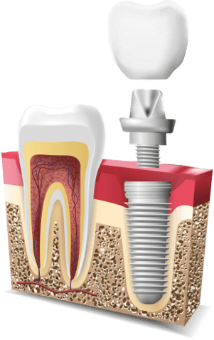 oral_surgery_implant oral_surgery_implant