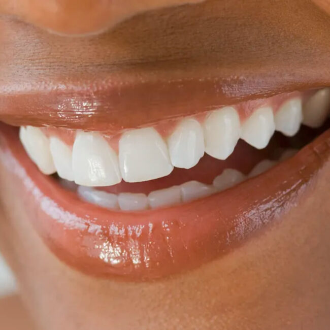 Teeth Whitening_dubai Teeth Whitening