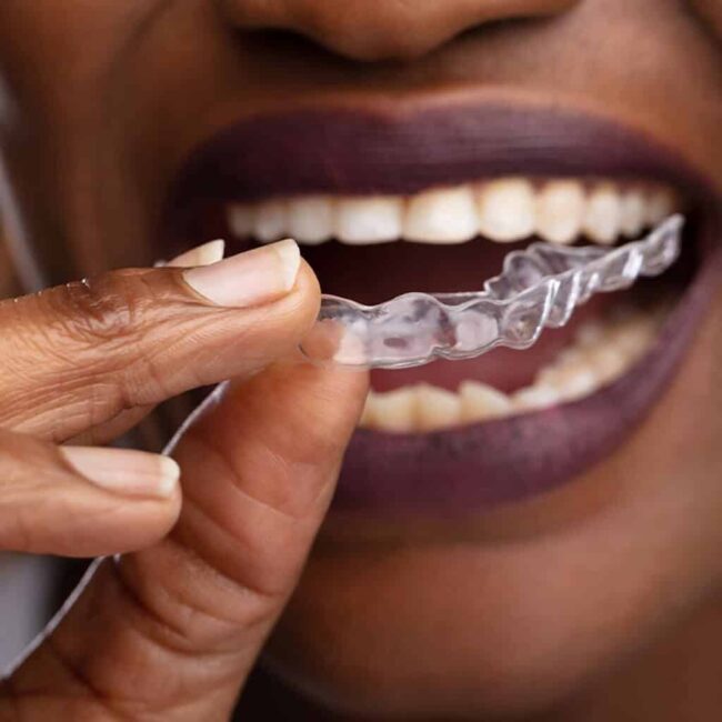 dental gum shield Dental Gum Shield