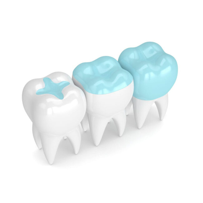 Biocompatible tooth filling dubai