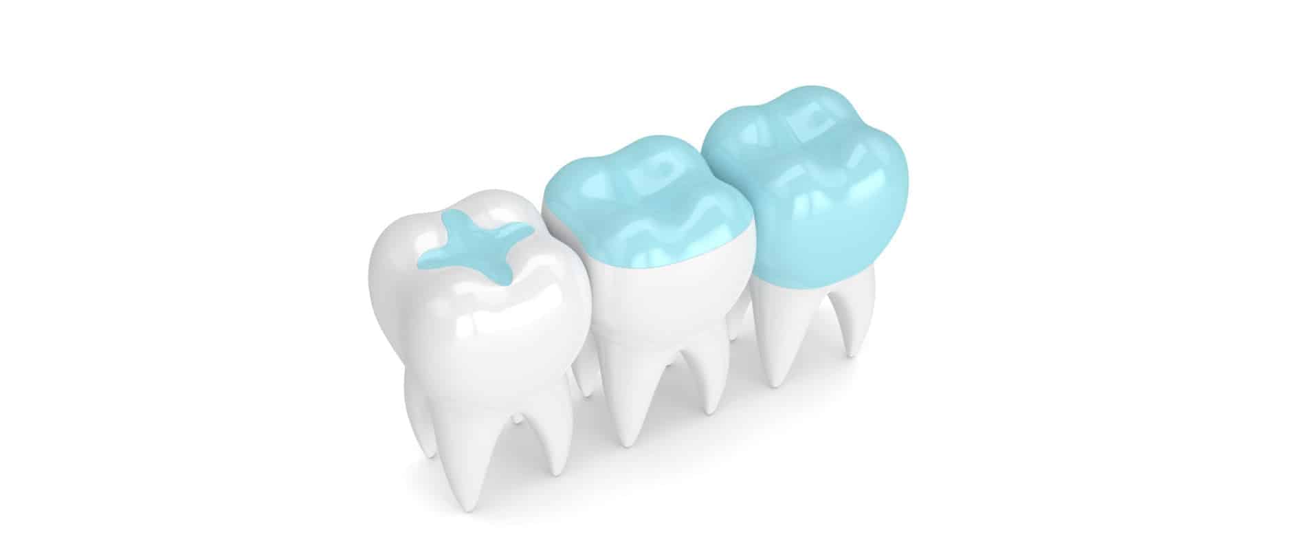 Biocompatible tooth filling