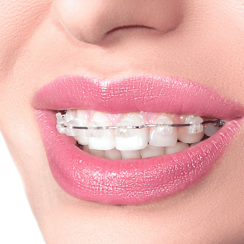 Ceramic_Braces_Dubai