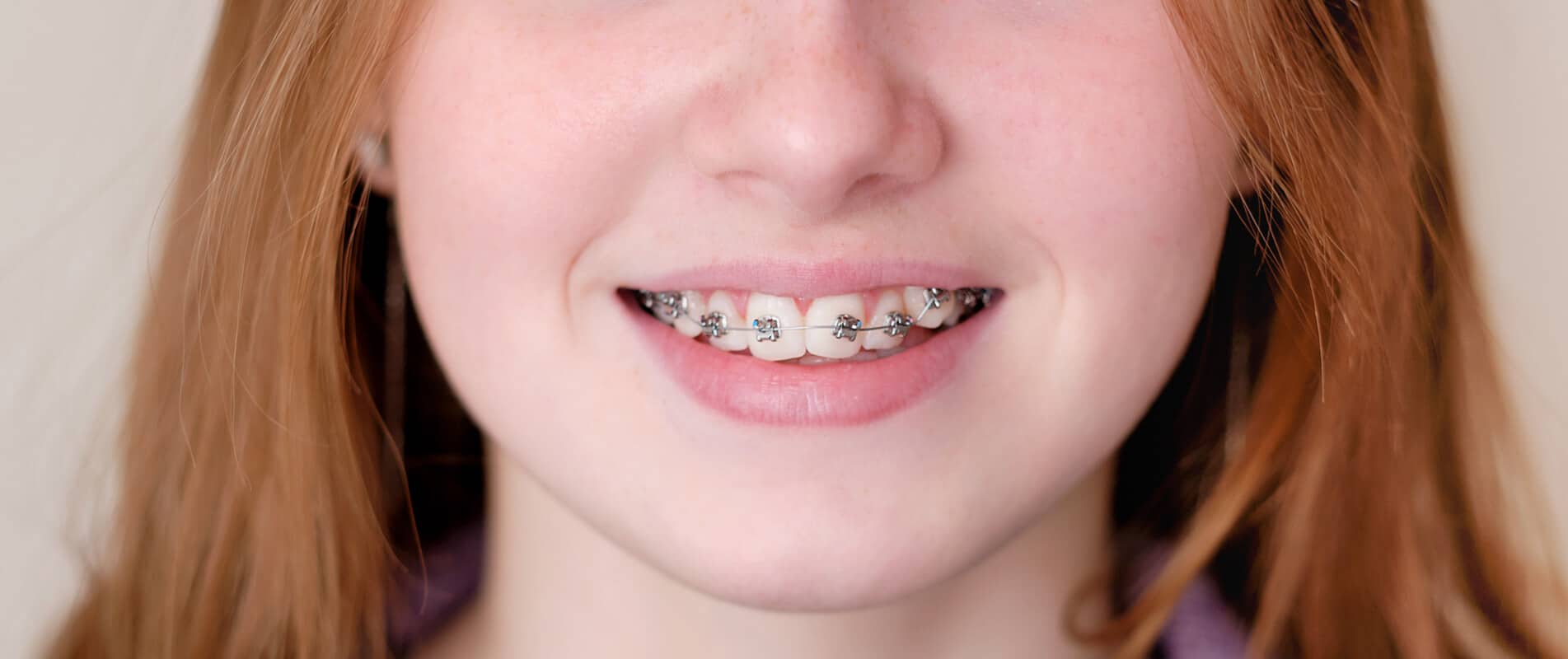 metal_braces