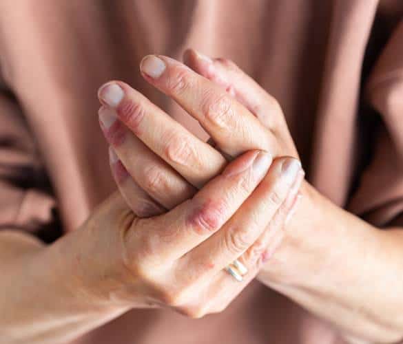 Dermatitis and eczema Dermatitis and eczema