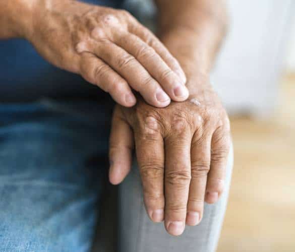 Psoriasis Psoriasis
