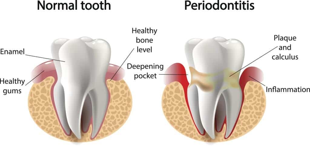 periodontitis treatment