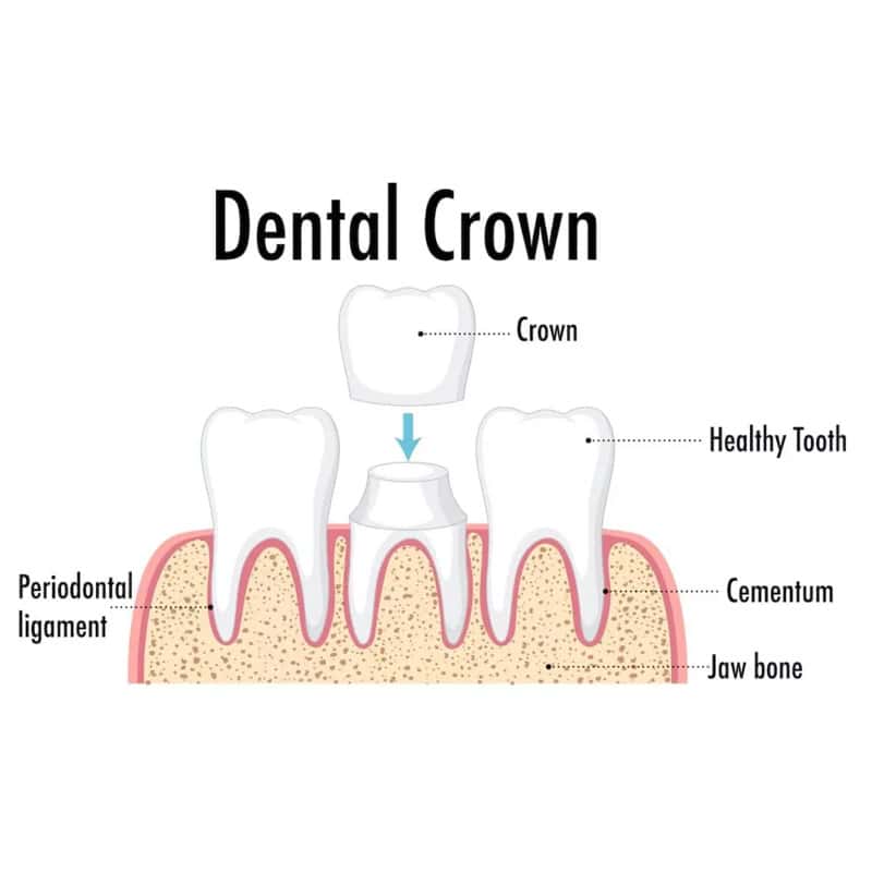 dental-crown-jumeirah same day dental crown