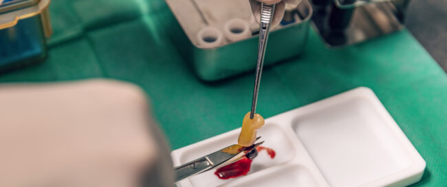 PRF platelet rich fibrin therapy