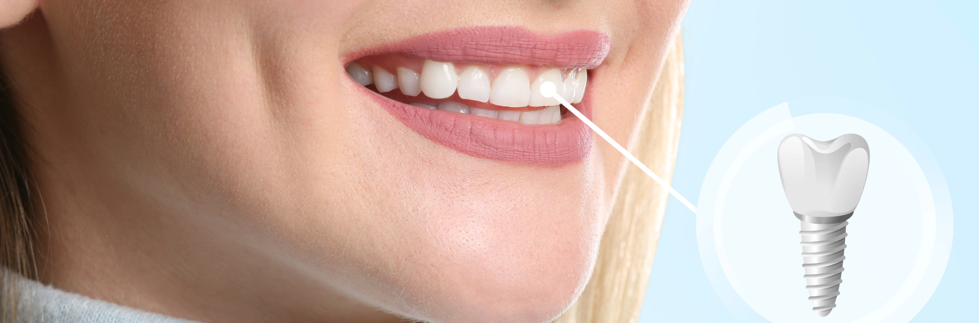 Dental_Ceramic_Implant_roze_Dubai