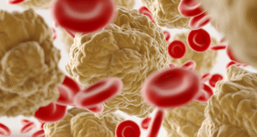 PRF_Platelet_rich_fibrin