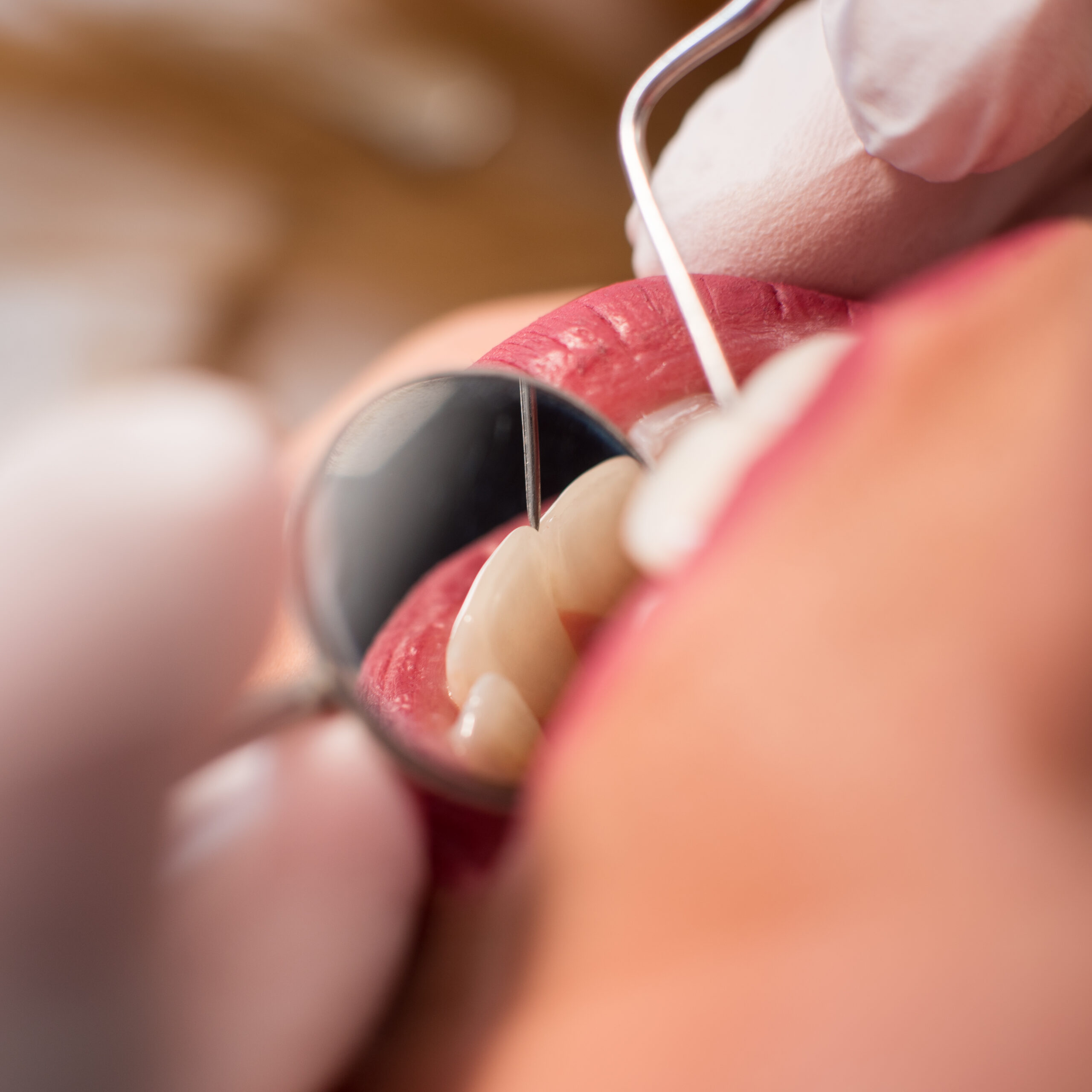 Macro shot of girl having dental check up in dental clinic. Dentist examining a patient's teeth cavities